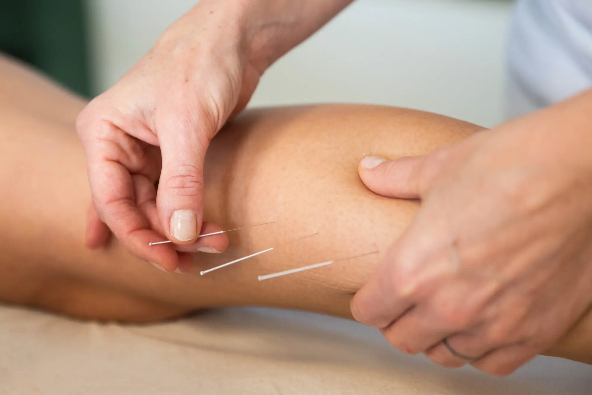Suho iglanje - dry-needling